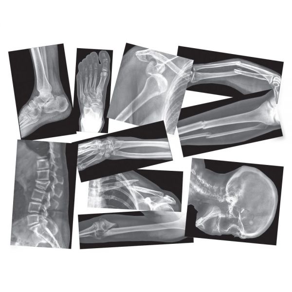 RYLR5914 Roylco Broken Bones X-rays Set